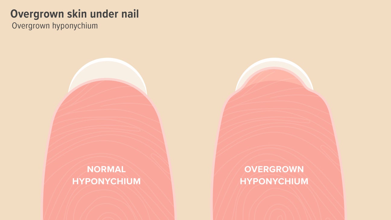 Hyponychium Separating From Nail Bed wasaga beach break fast ca