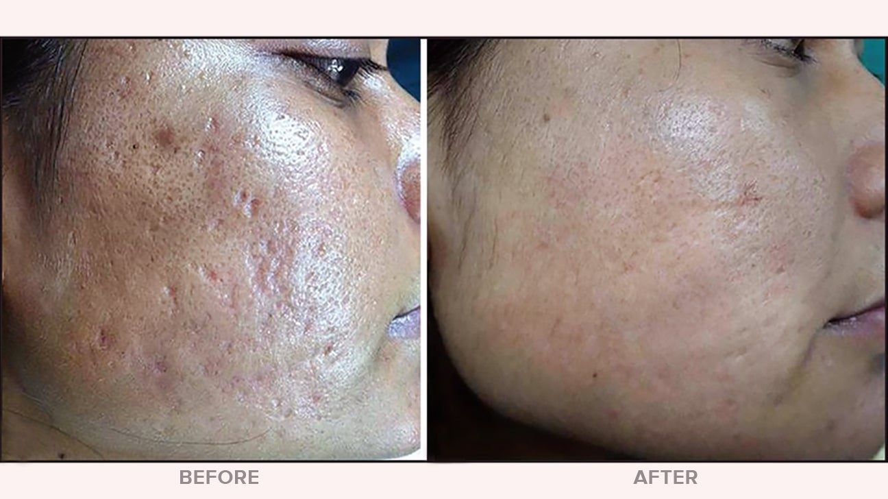after microneedle treatment