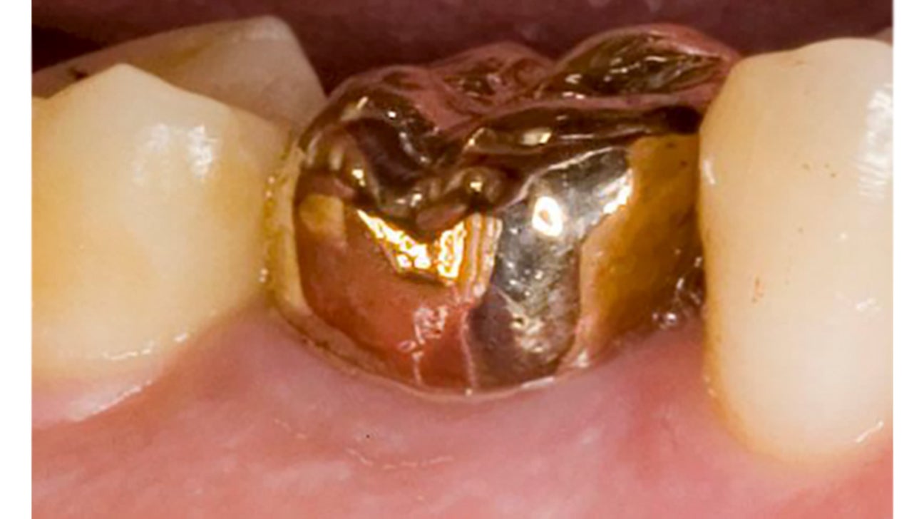 Dental Crown Types Procedure When It S Done Cost And Aftercare