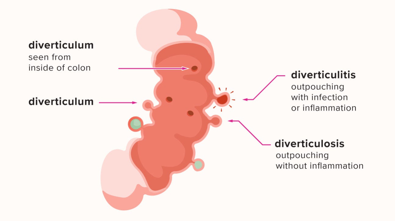 What's the Difference Between Diverticulitis and Diverticulosis?