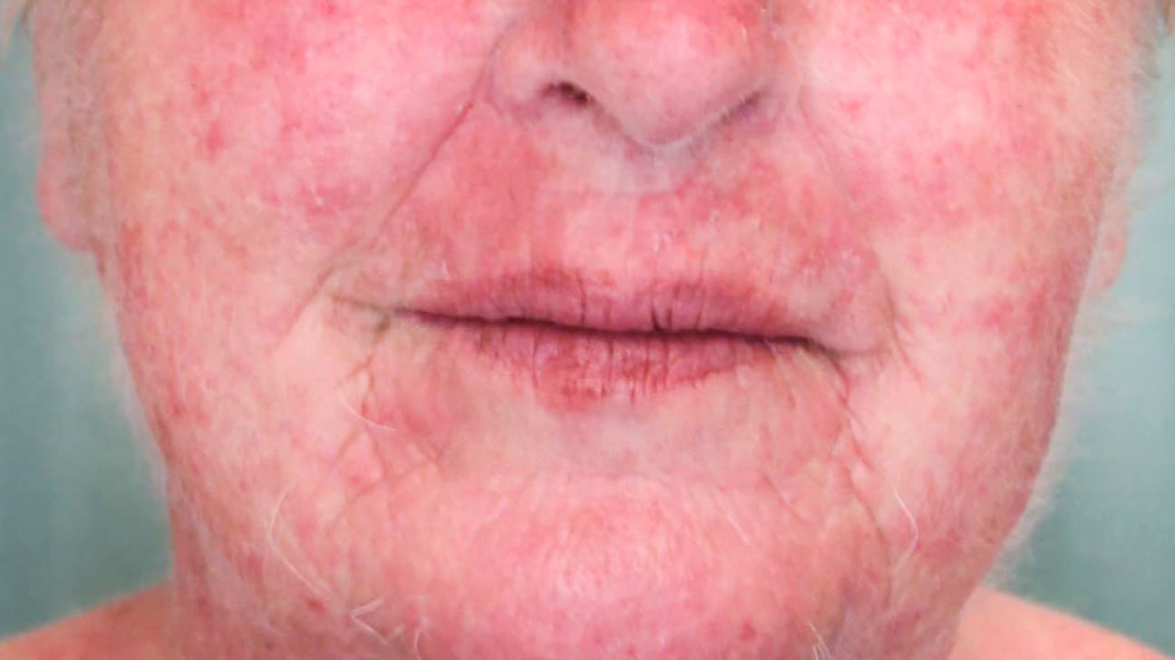 Allergic reaction rash to face