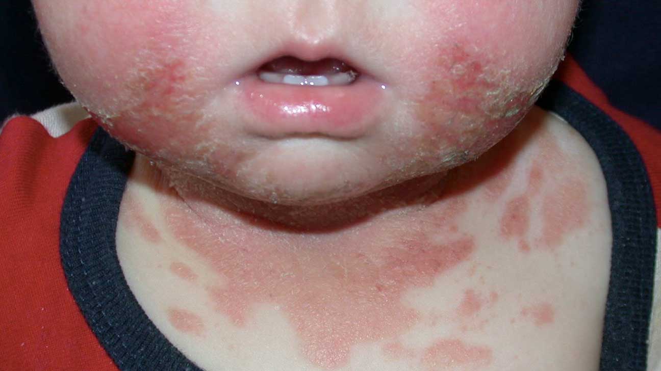 How do i treat an allergic reaction on my face