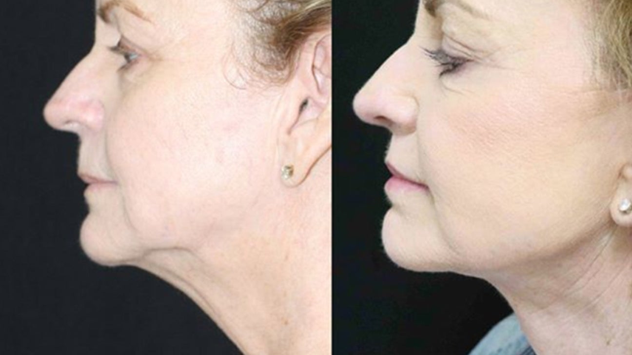 Chin Sculpting, Permanent Double Chin Removal