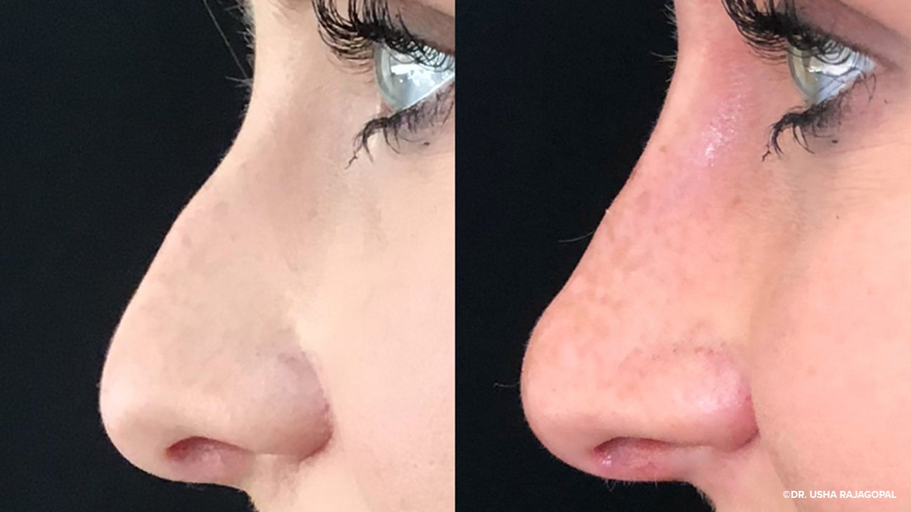 Nose am. Non-Surgical Rhinoplasty. Scrunch nose.