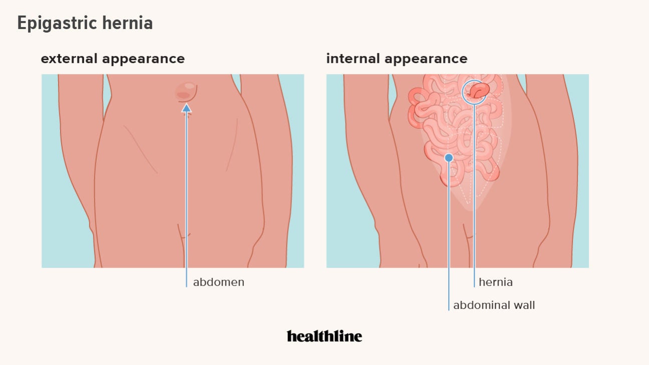 Types of Hernias  The Hernia Clinic