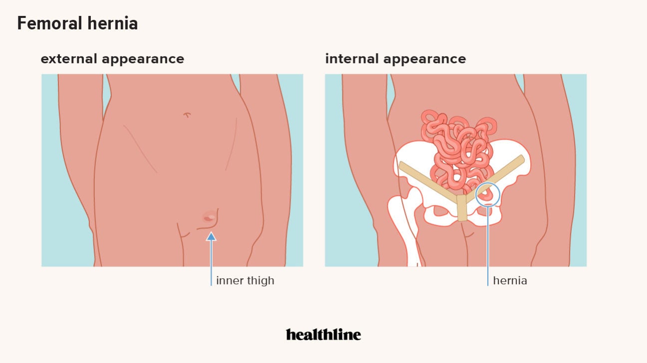 Hernia Pictures of 6 Common Types