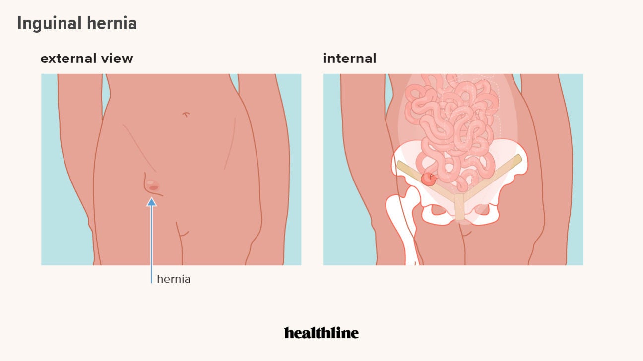 human biology - What are the coverings of femoral hernia