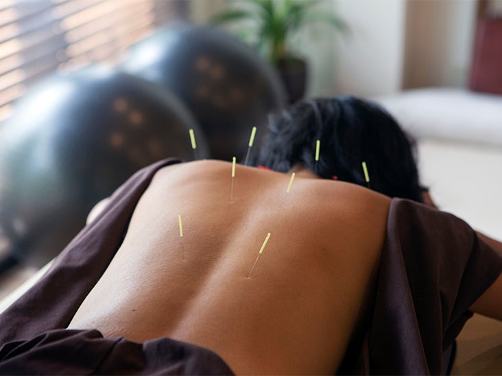 Acupuncture and Acupressure May Ease Pain Associated with Cancer