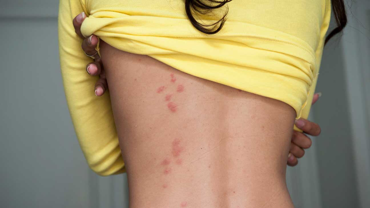 Chigger Bites Vs. Bed Bug Bites: Telling Them Apart