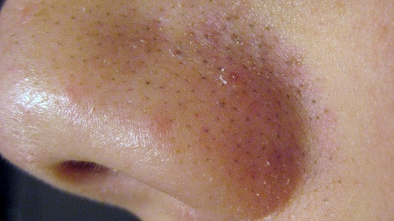 mild acne vulgaris