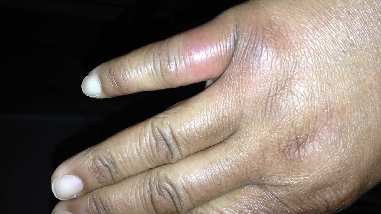 Bug Bite Swelling Hand