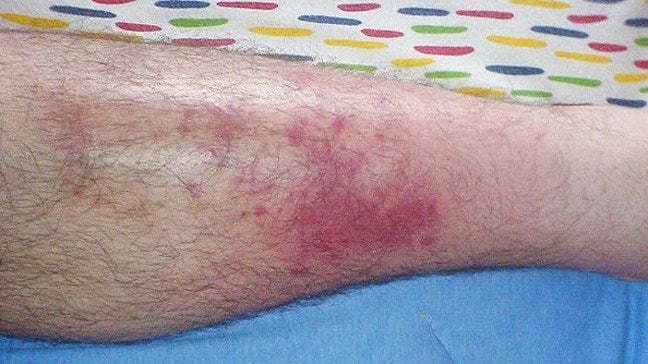 cellulitis knee