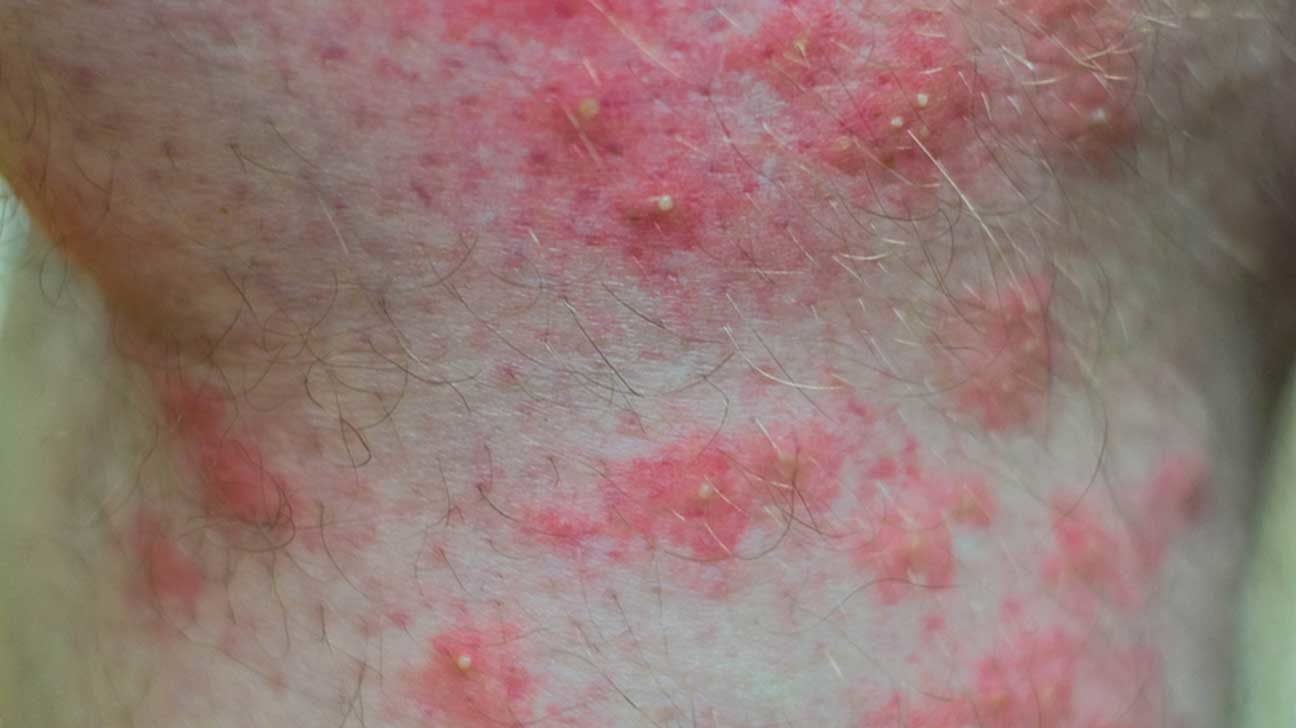 Bites and Stings: Pictures, Causes, Symptoms, and Treatment