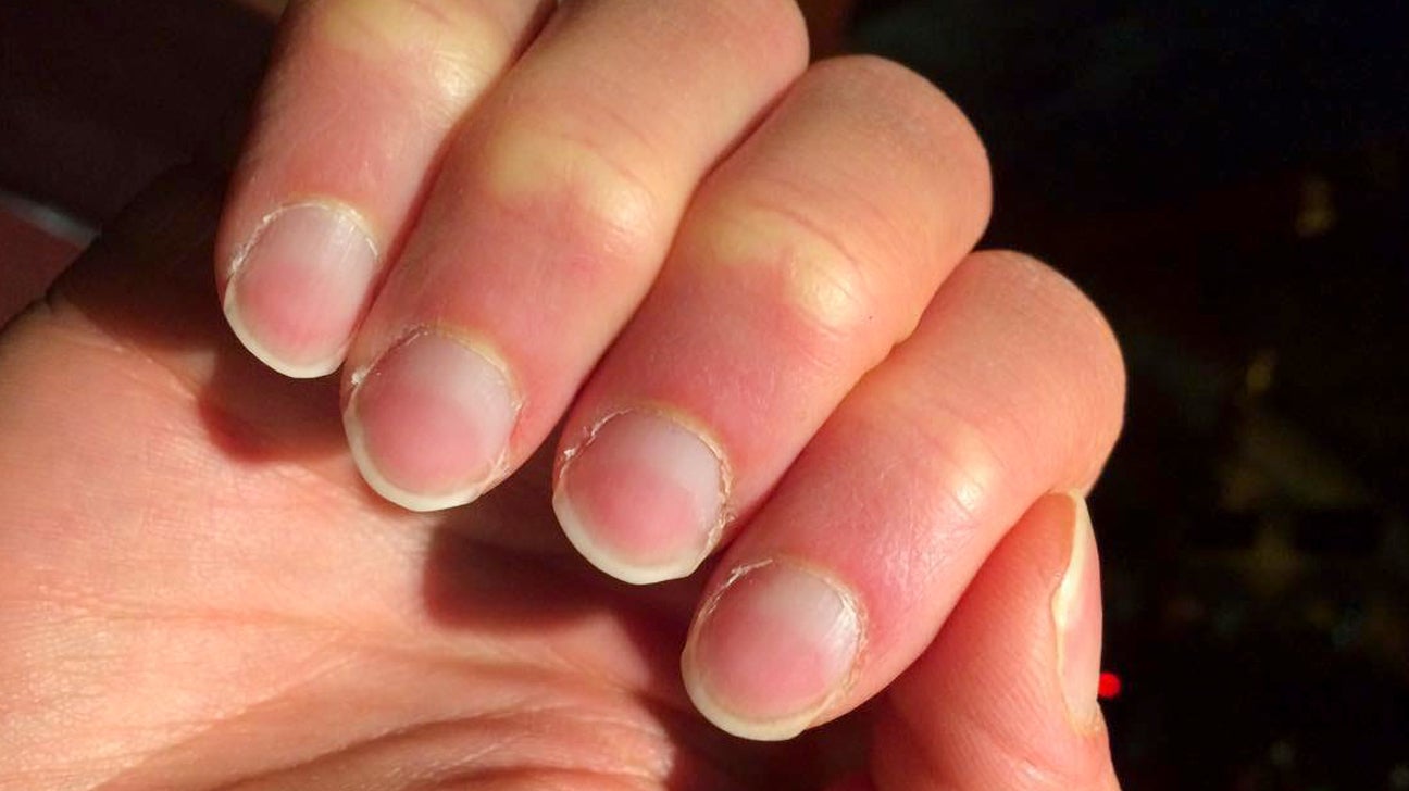 gombák finger nail leállítása a kezelés nail forming form