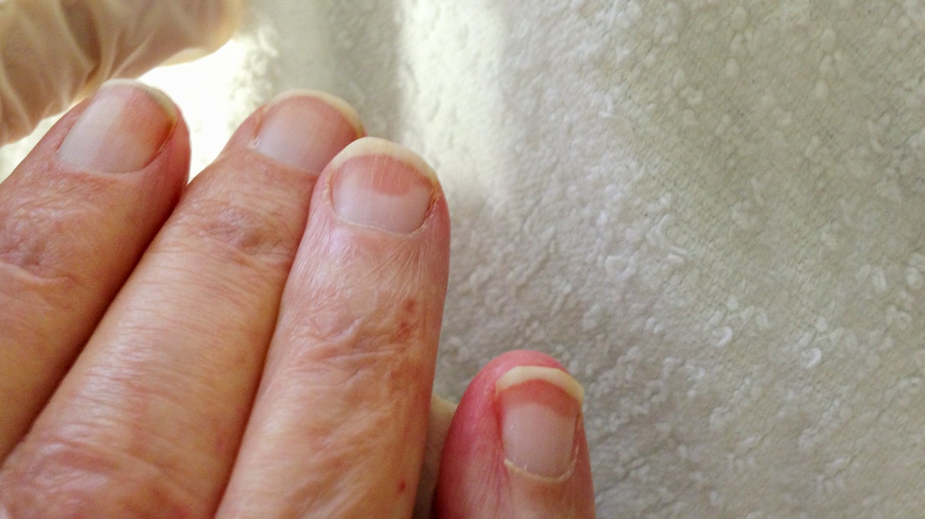 An Atlas of Nail Disorders, Part 11 | Consultant360