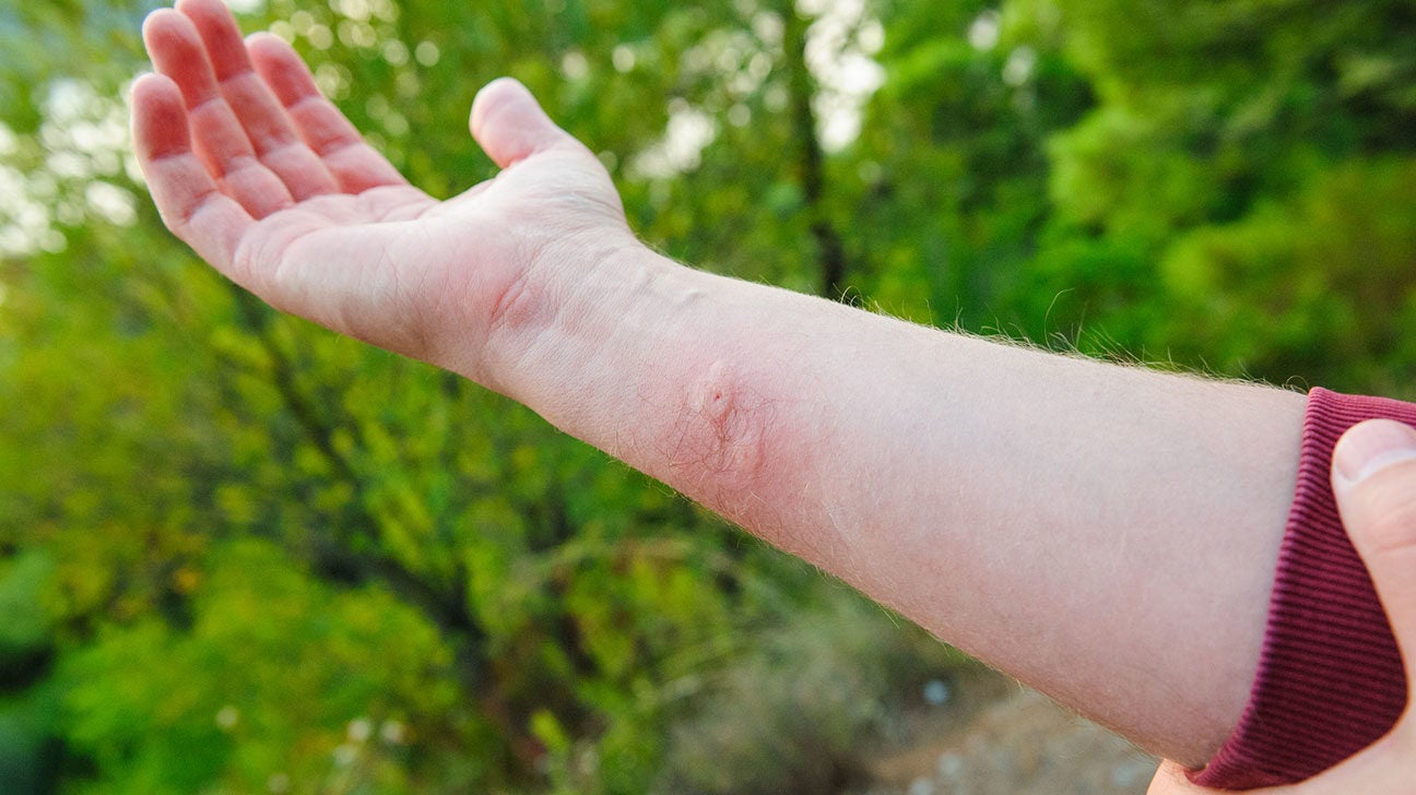Bites and Stings Pictures, Causes, Symptoms, and Treatment