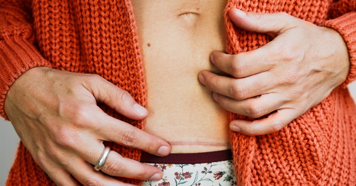 C-Section Scars: Types of Incisions, Healing, and Minimizing Scars
