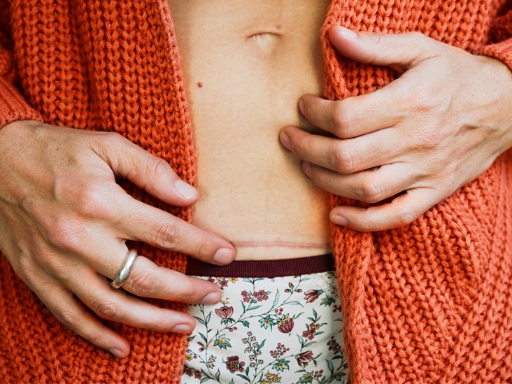 CSection Scars Types of Incisions, Healing, and Minimizing Scars