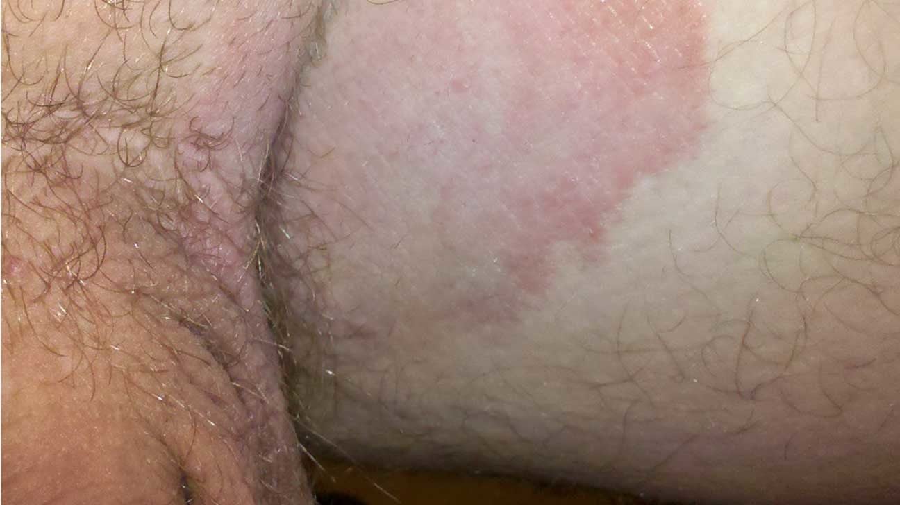Itching: What's Causing Your Itchy Skin? (with Pictures)