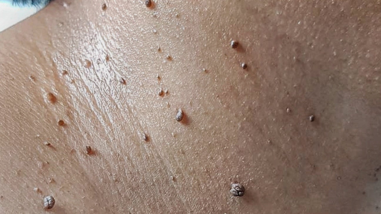 I sometimes get little skin tags where my bra sits. Never one like this,  though! Getting it cauterised tomorrow as it's extremely painful. :  r/popping
