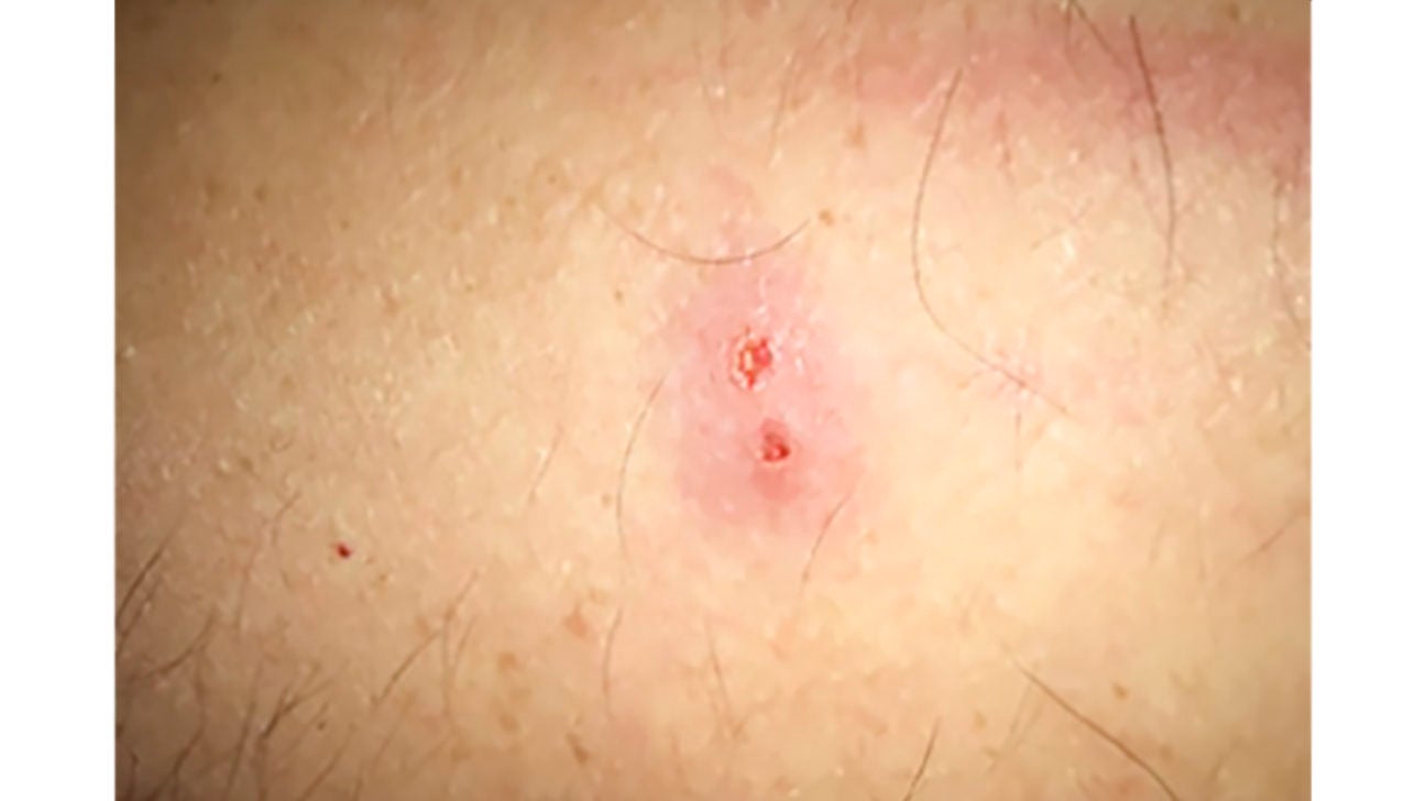 human bite marks on skin