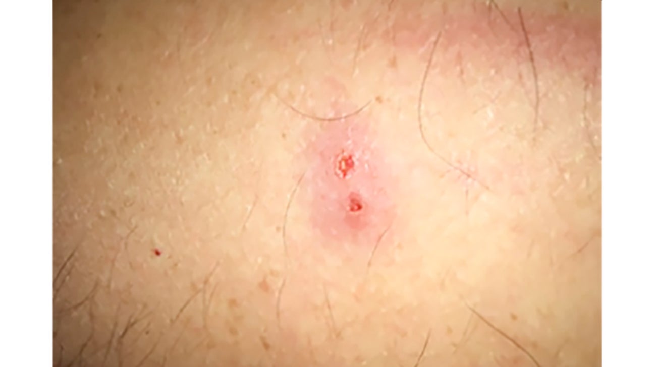 Day 1 Black Widow Spider Bite Stages Black Widow Spider Bites On Dogs 