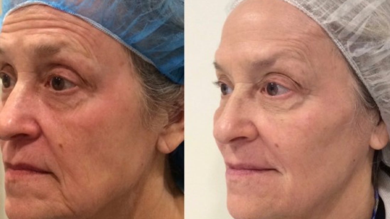 Best Facelift Surgeon In Miami