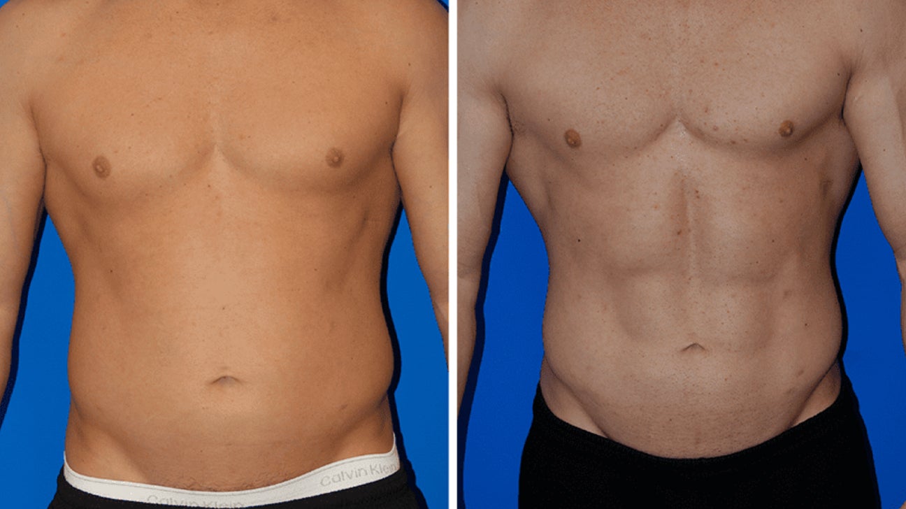 VASER Liposuction: Procedure, Cost, and What to Expect