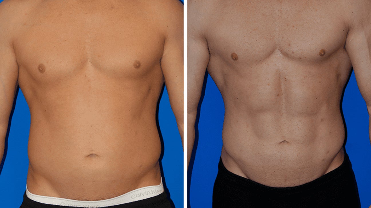 Abdomen & Flanks VASER Liposuction Sacramento