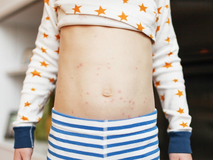 What to Eat When You Have Chickenpox — and What to Avoid