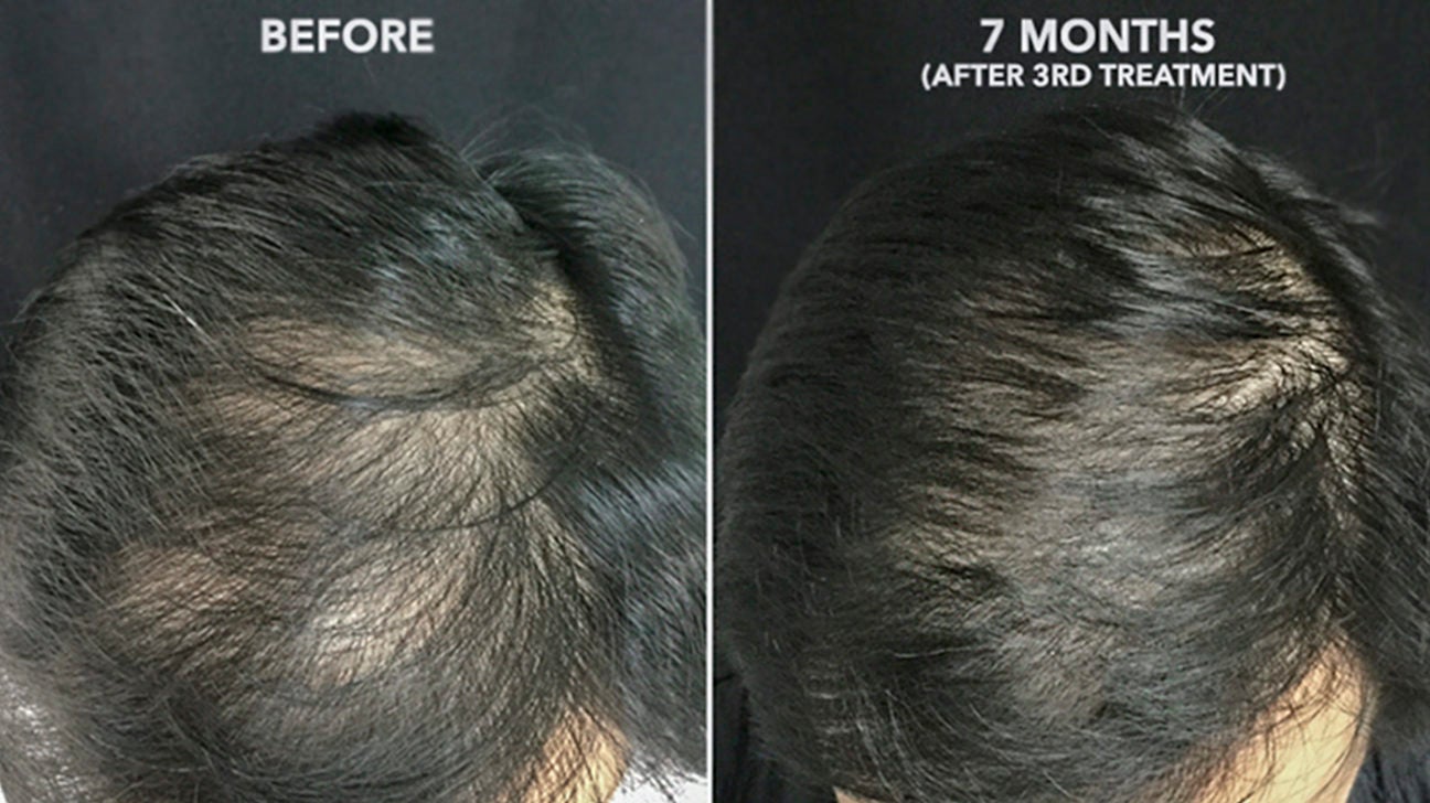 PRP Hair Treatment Success Rate: Does It Work for Hair Loss?