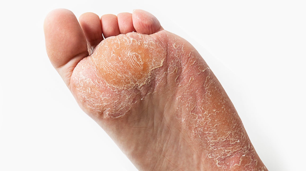 cracked skin on balls of feet