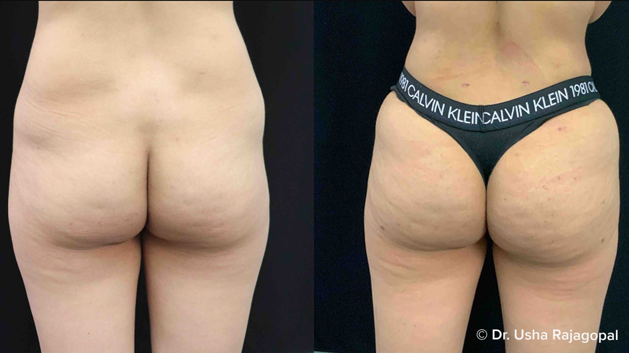 What You Need To Know: Brazilian Butt Lifts vs. Butt Implants – Aristocrat  Plastic Surgery