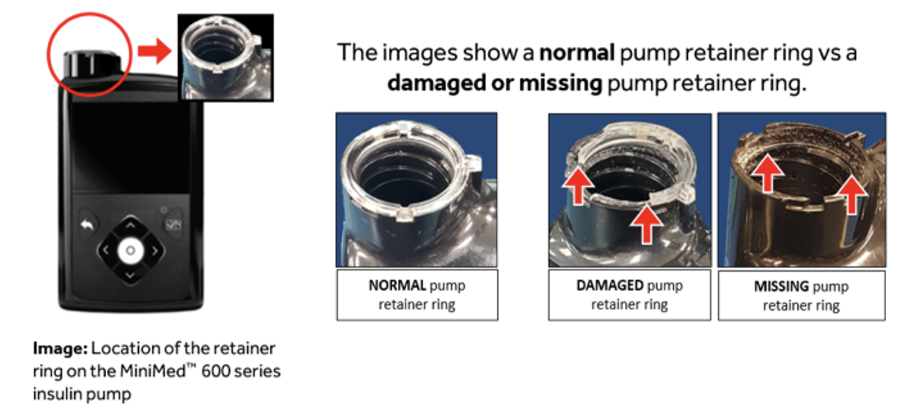 Patient Impact of Diabetes Device Recalls