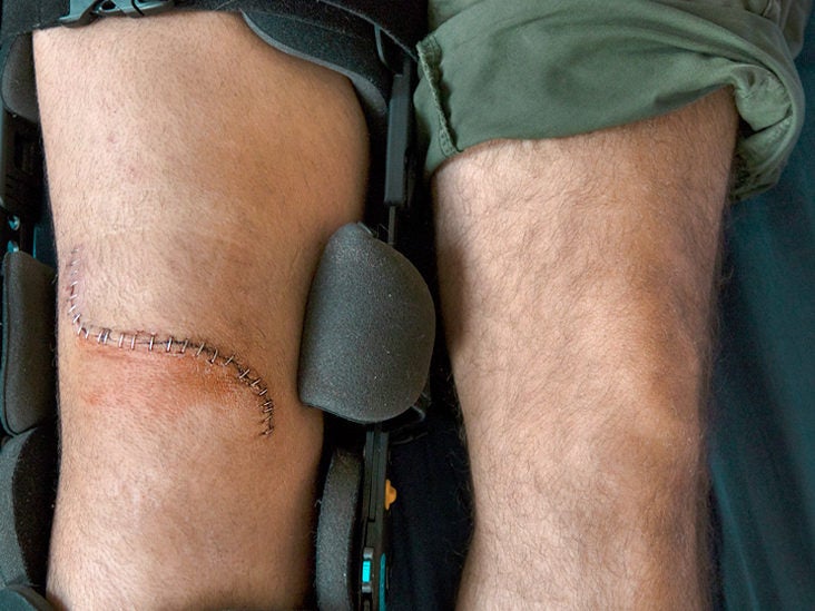 What To Expect With An Artificial Knee