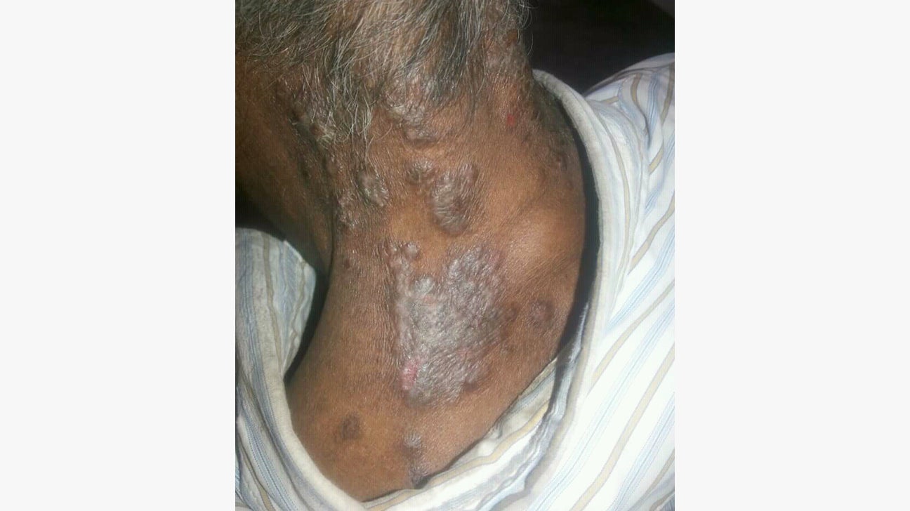 dark psoriasis scars