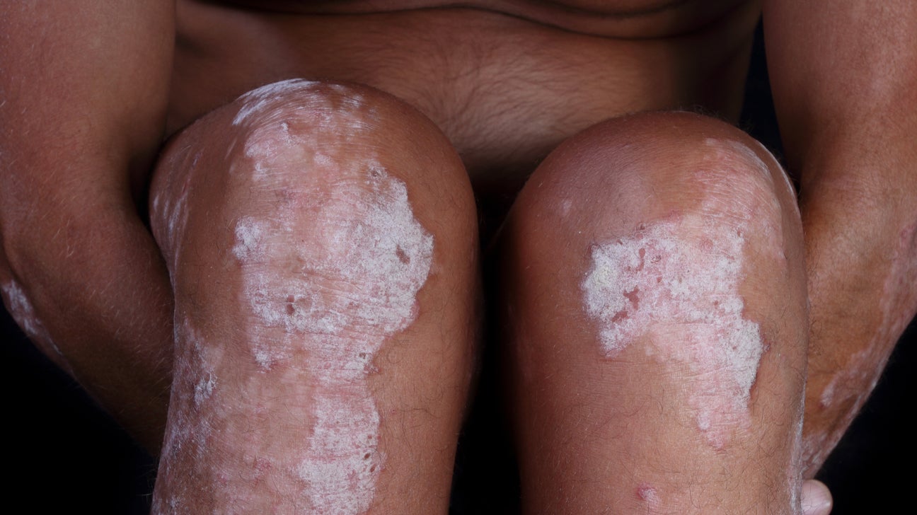 Psoriasis vulgaris láb | Sanidex Magyarországon