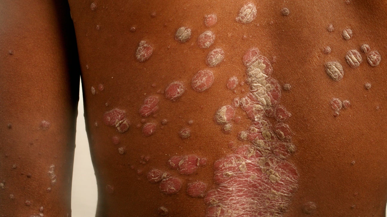 psoriasis skin of color