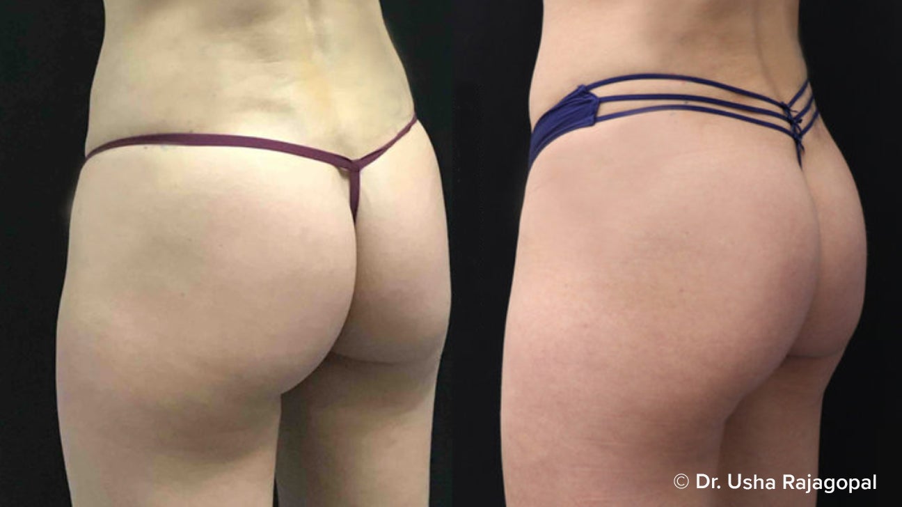 Brazilian Butt Lift (Condensed Rich Fat Injection To Enhance Buttocks)