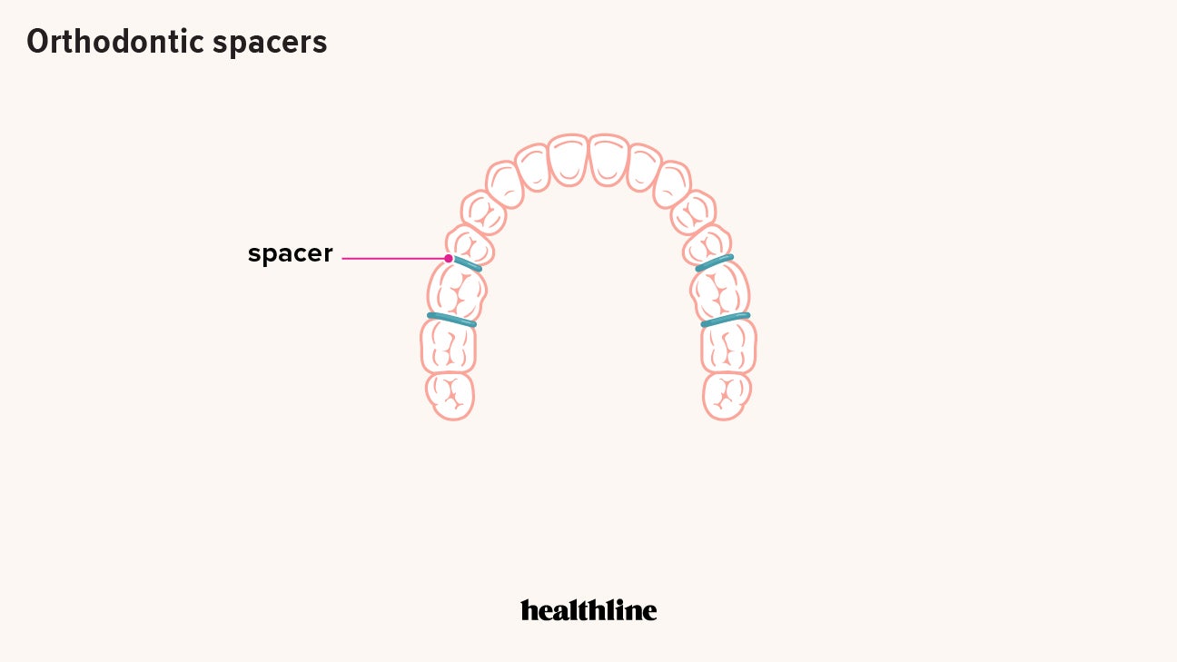 Spacers for Braces How They’re Used, If They Hurt, and Oral Care