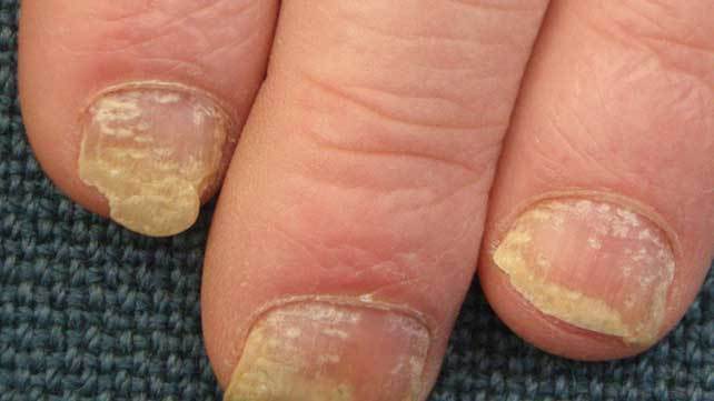 how to treat psoriasis on nails