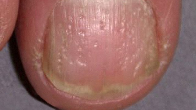 Photo Nail Psoriasis