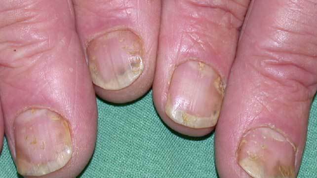 how to hide nail psoriasis