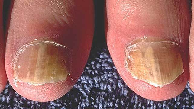 nail psoriasis toenails lehetséges- e pikkelysömör kezelése sós tóban