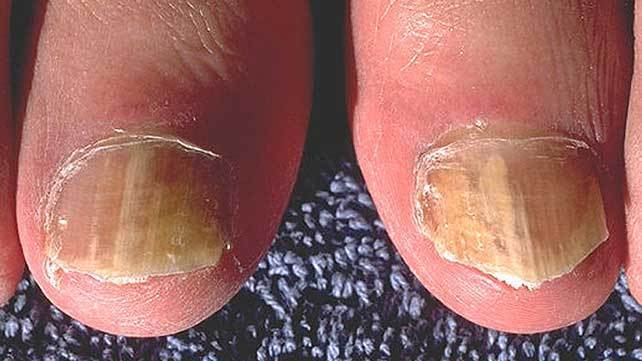 nail psoriasis toenails)