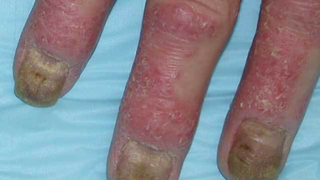 Nail matrix psoriatic manifestations visible on the nail plate 12 |  Download Scientific Diagram