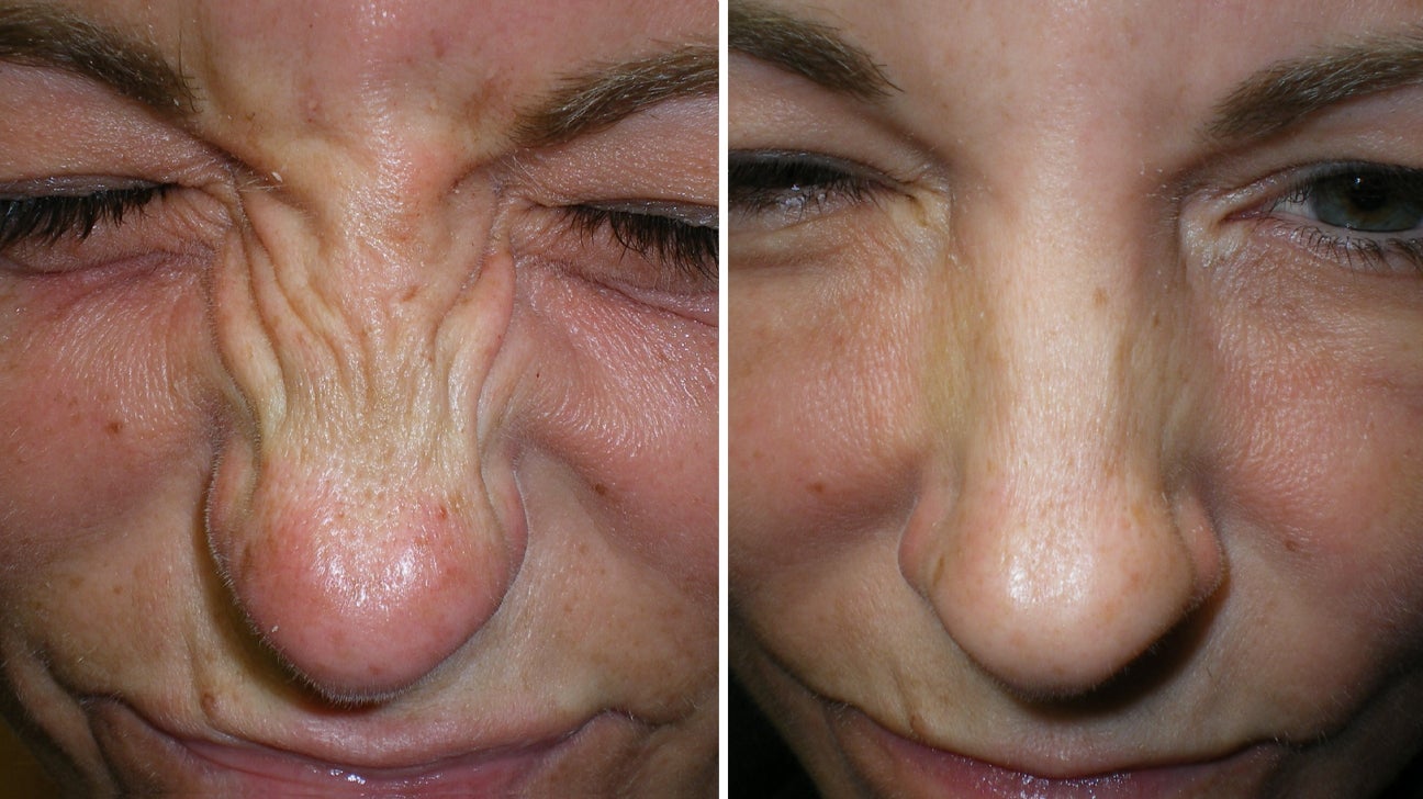 Chemical Peel Baltimore