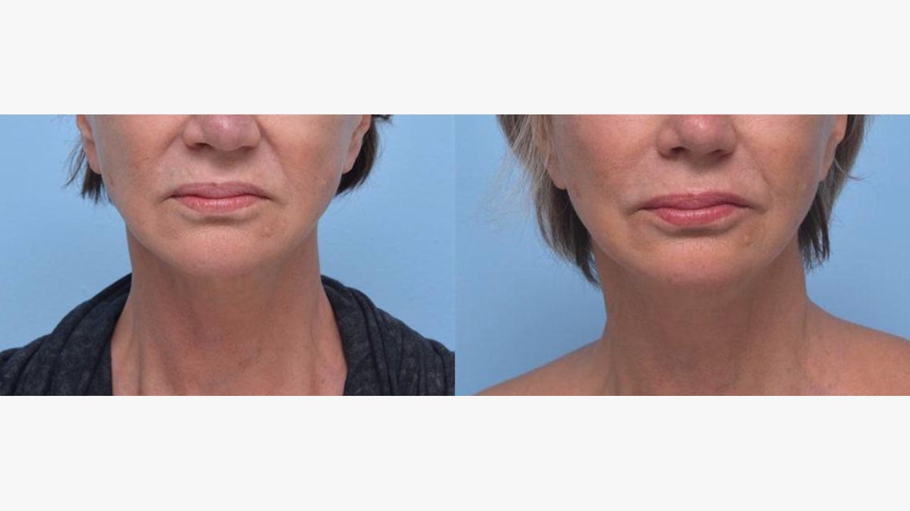 Botox Frown Lines Before And After