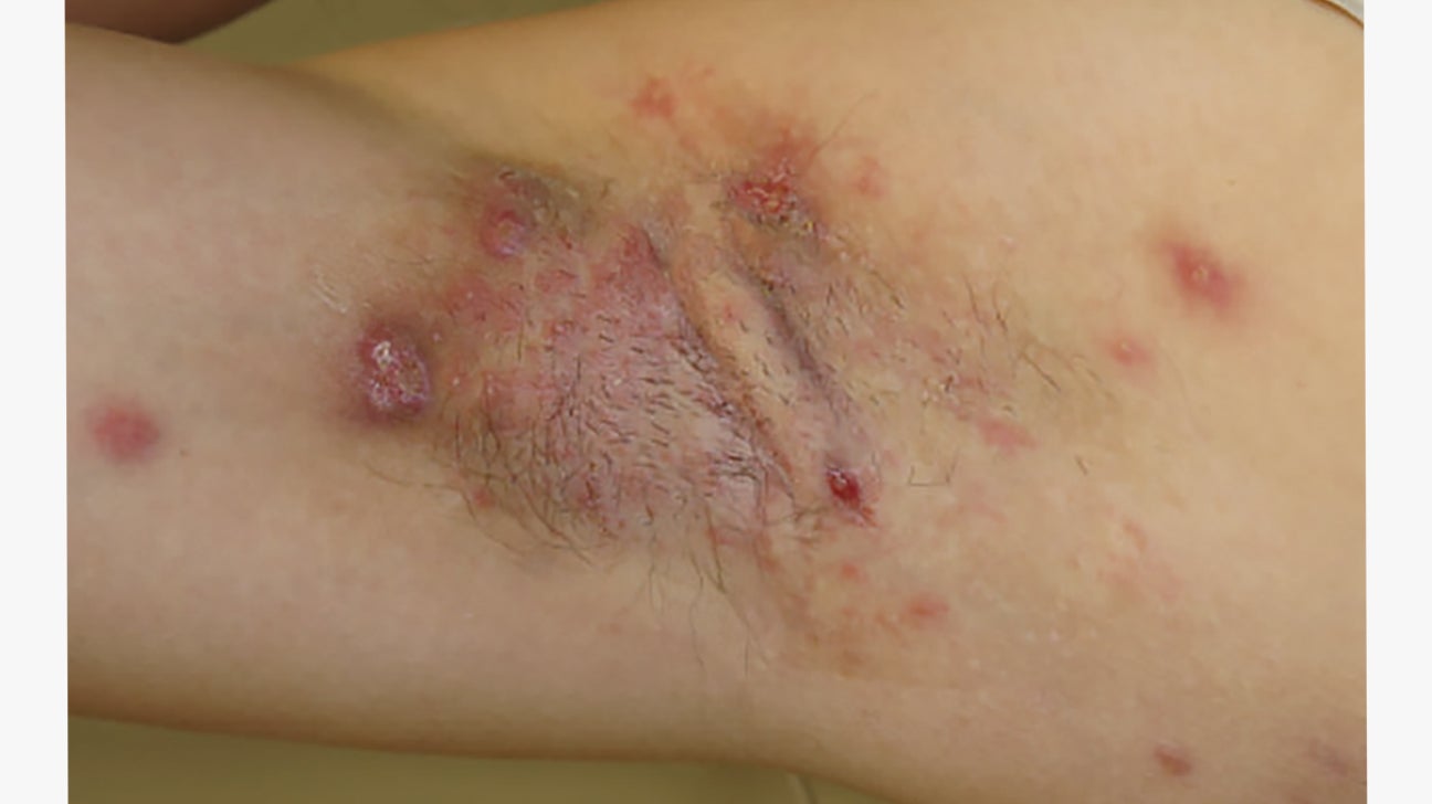 Hidradenitis Suppuritiva and Scar Removal - New Treatment