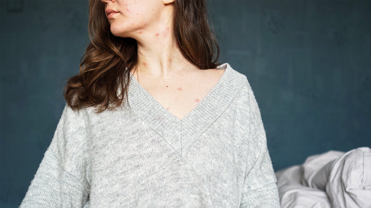 6 Things to Know About IUDs and Acne Triggers, Treatment, and More